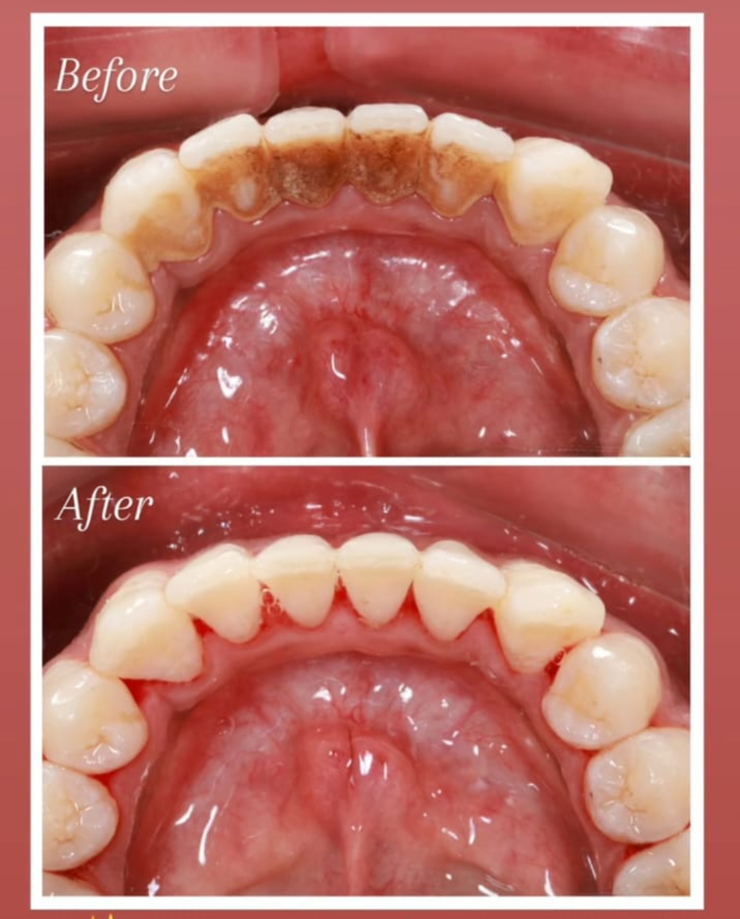 Before and after result: Dental Cleaning Result