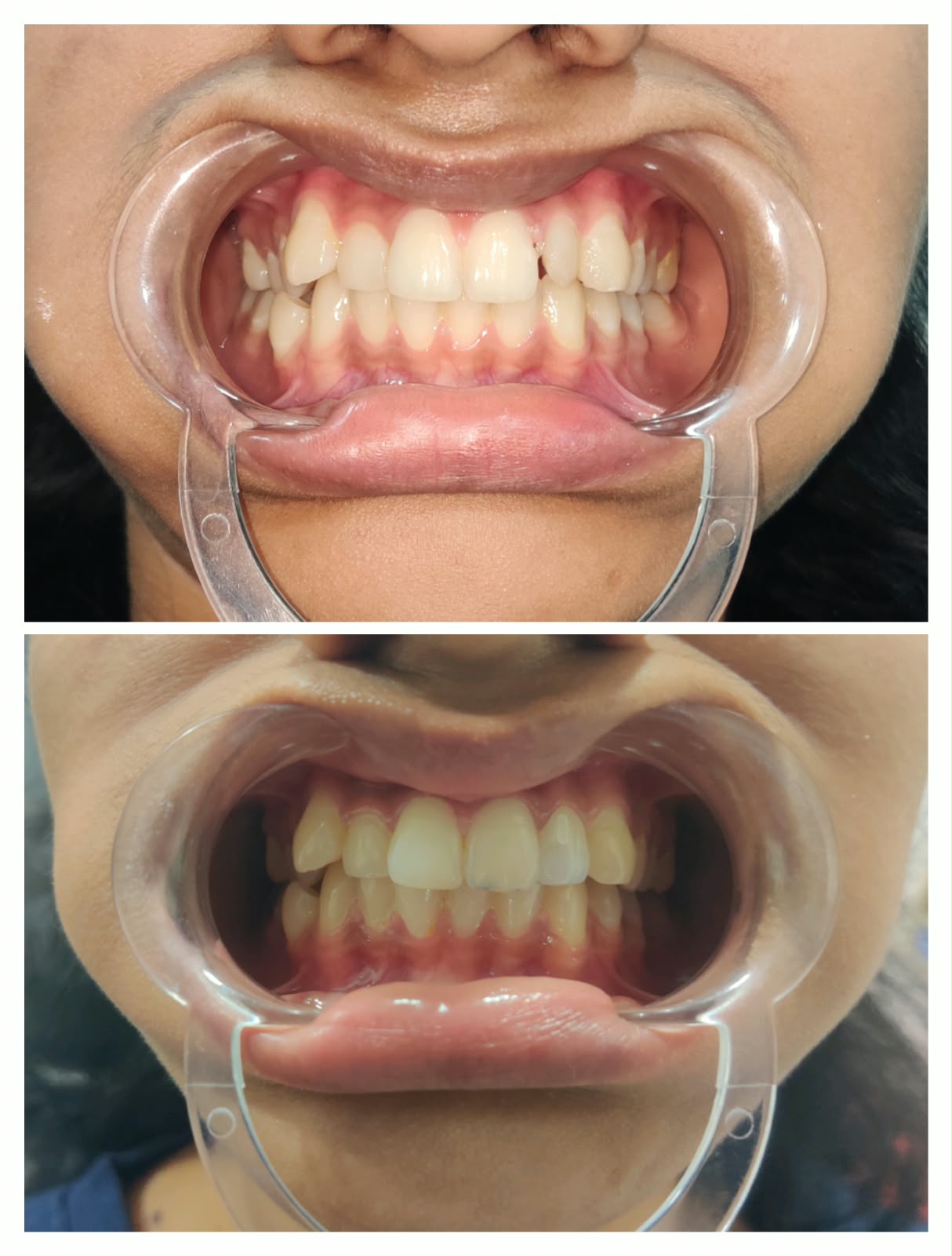 Before and after result: smile makeover