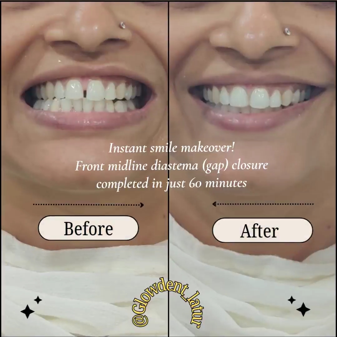Before and after result: Smile designing