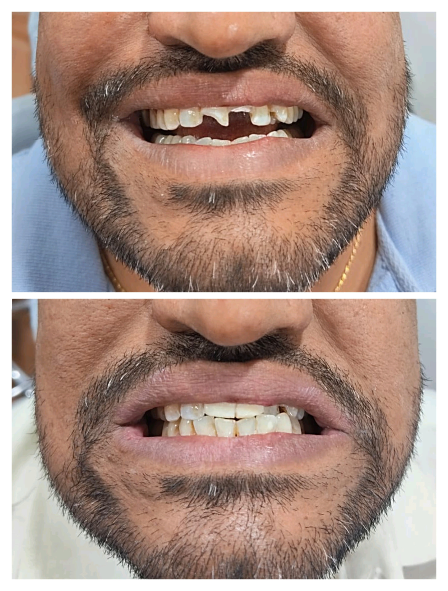 Before and after result: front tooth replacement