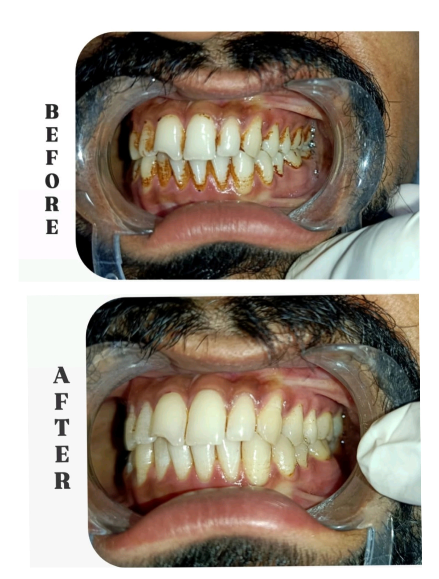 Before and after result: Cleaning & Aesthetic Improvement